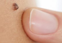 Cilt Kanseri Belirtileri