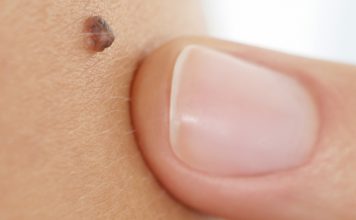 Cilt Kanseri Belirtileri