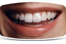 Diş Minesi ve Asit Aşındırması Nedir?