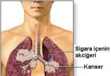 Akciğer Kanseri Belirtileri ve Tedavisi