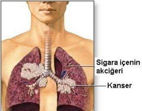 Akciğer Kanseri Belirtileri ve Tedavisi