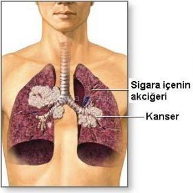 akciger_kanseri_sigara