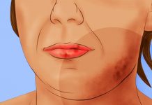 Lupus Hastalığı Nedir?