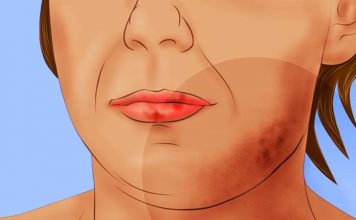 Lupus Hastalığı Nedir?