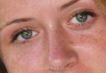 Çillerden Kurtulma Yöntemleri