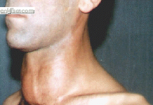 Guatr hastalığının belirtileri